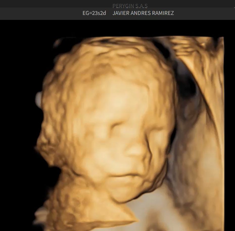 Imagen ecográfica tridimensional del rostro de un bebé