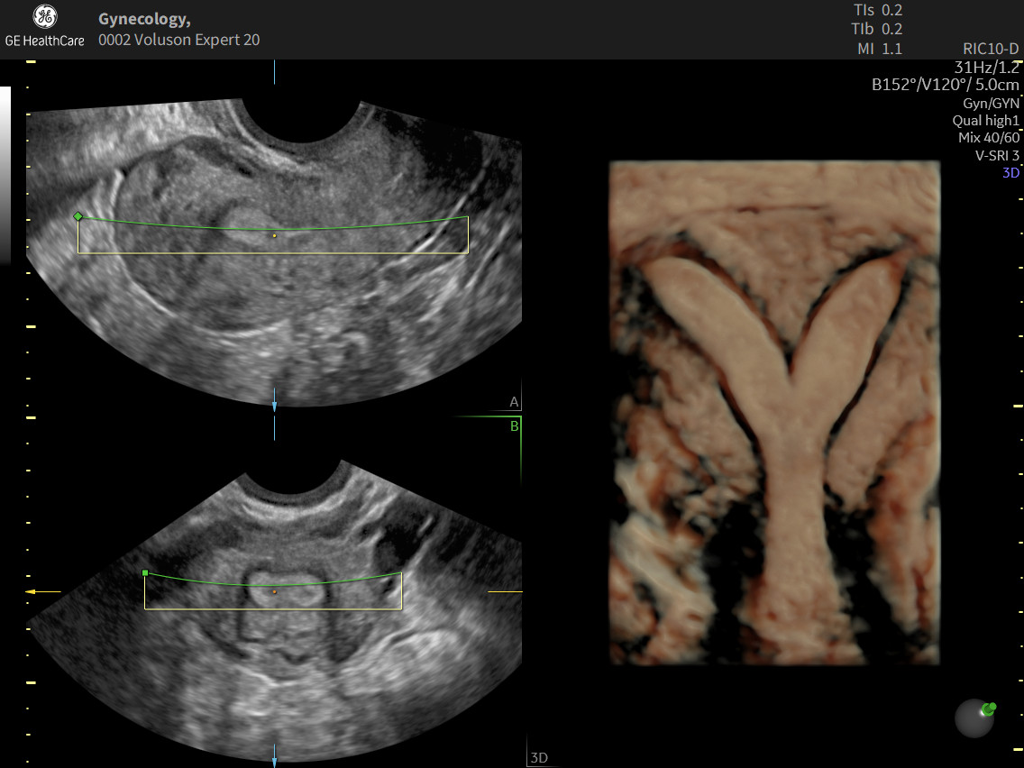 Ecografía ginecológica con visualización 2D y reconstrucción uterina en 3D